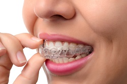 Greenville, NC Invisalign clear teeth aligners
